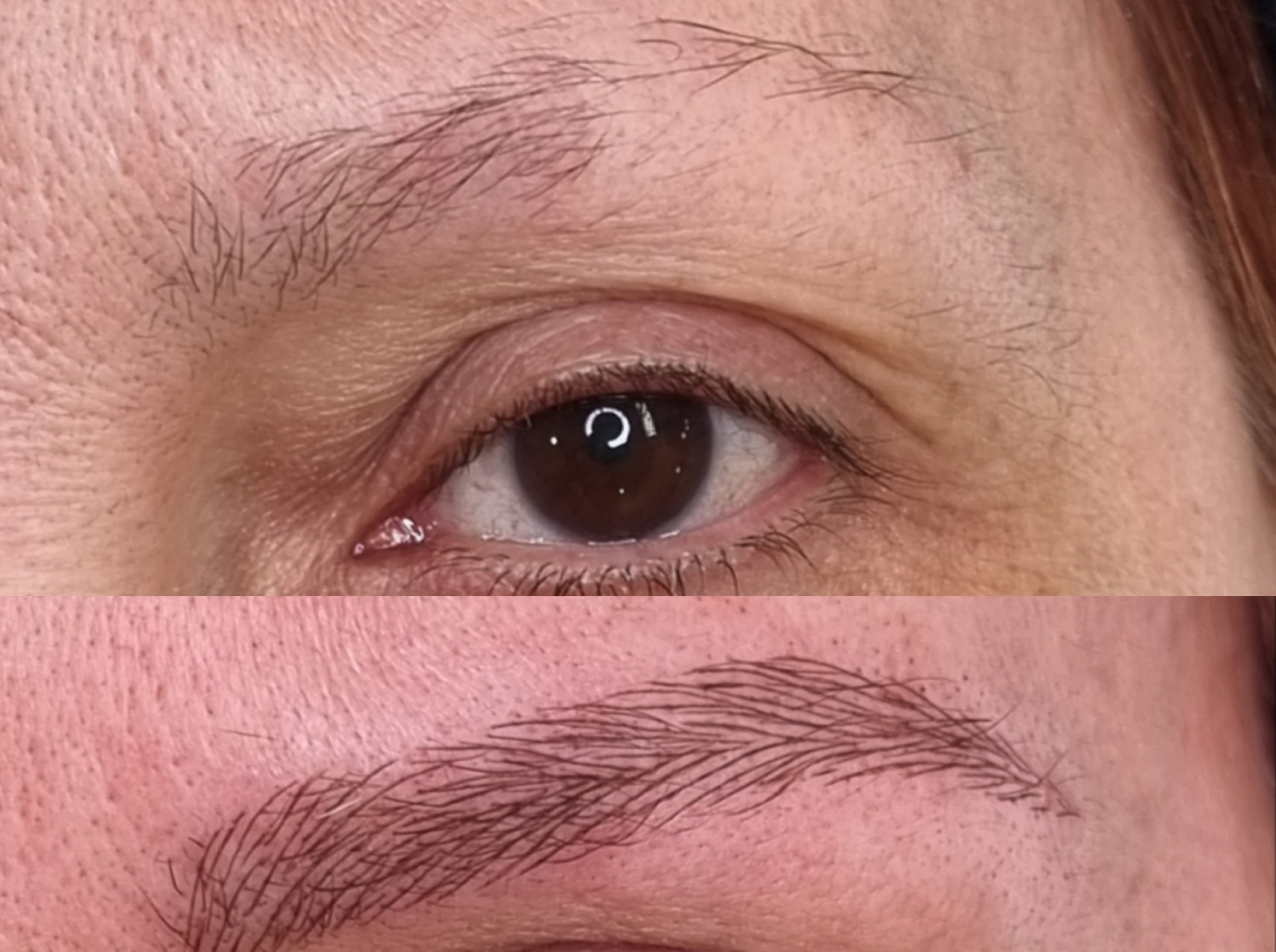 Antes/después - reconstrucción por alopecia