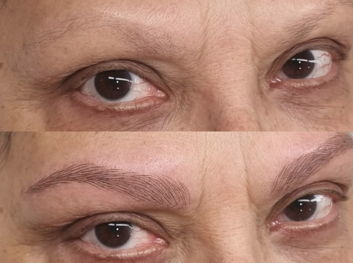 Resultado cicatrizado a los 2 meses